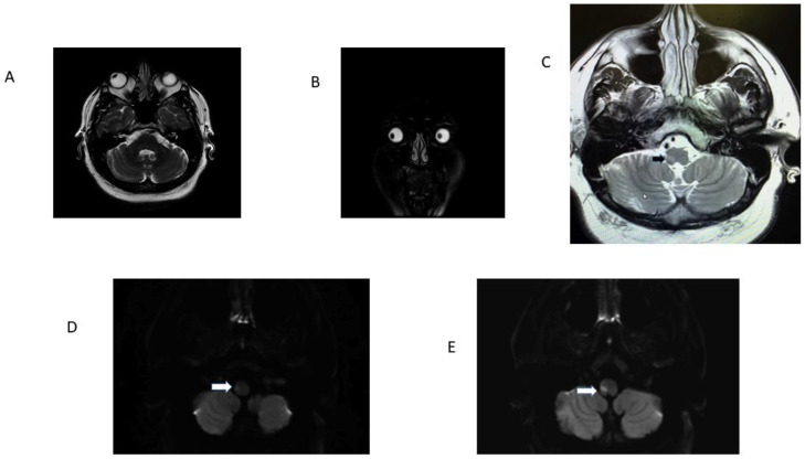 Concordant GRADE-3 Truncal Ataxia and Ocular Laterodeviation in Acute Medullary Stroke.