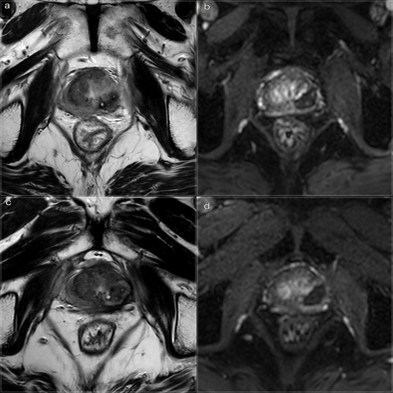 Transperineal laser ablation (TPLA) with ultrasound/MRI fusion guidance in the treatment of localized radiotherapy-resistant prostate cancer.