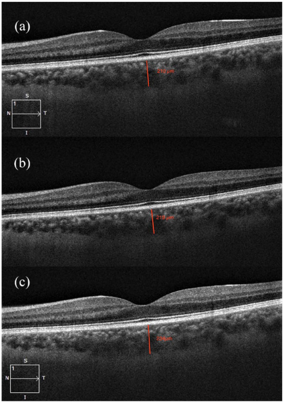 The effect of off-pump coronary bypass graft surgery on subfoveal choroidal thickness, ganglion cell complex, and retinal nerve fiber layer thickness.