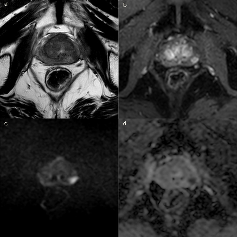 Transperineal laser ablation (TPLA) with ultrasound/MRI fusion guidance in the treatment of localized radiotherapy-resistant prostate cancer.