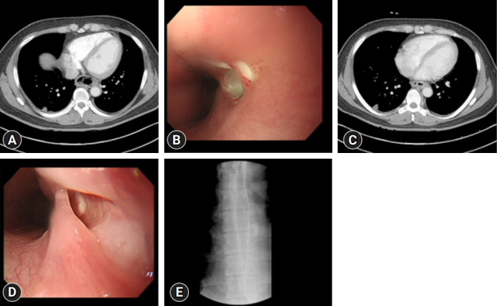 Treatment of phlegmonous esophagitis in various patients: a case series.