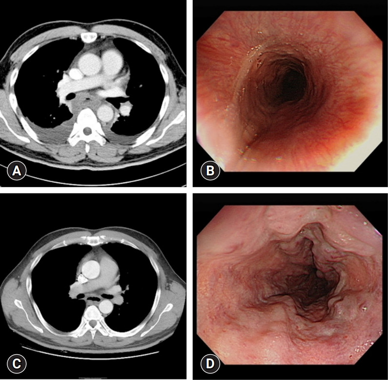 Treatment of phlegmonous esophagitis in various patients: a case series.