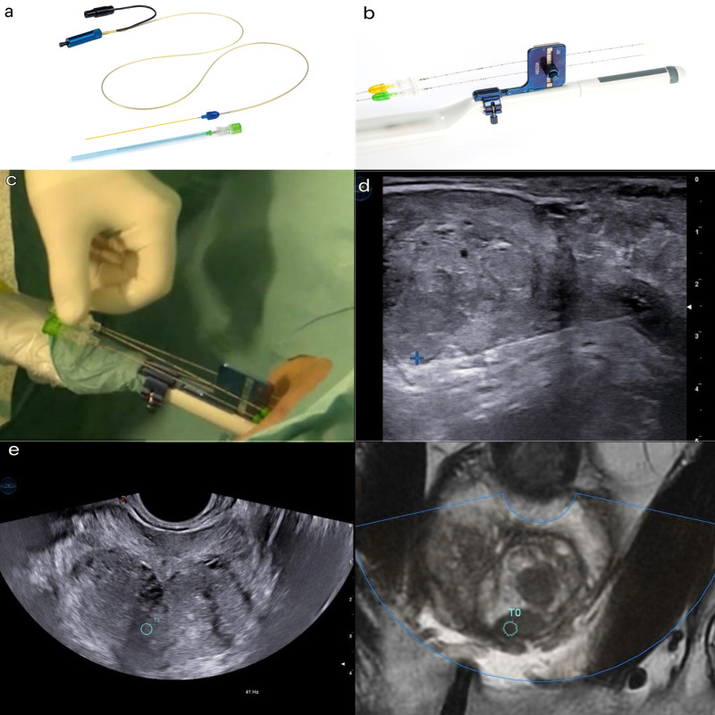 Transperineal laser ablation (TPLA) with ultrasound/MRI fusion guidance in the treatment of localized radiotherapy-resistant prostate cancer.