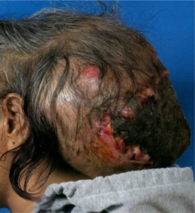 Fibrosarcomatous dermatofibrosarcoma protuberans: a rapidly growing 30 cm mass on the posterior scalp.