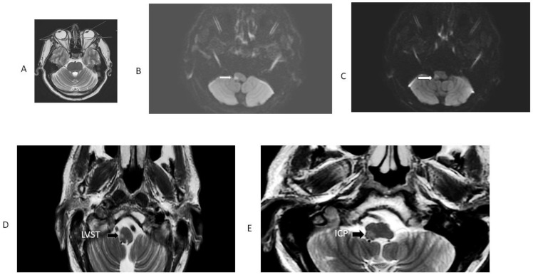 Concordant GRADE-3 Truncal Ataxia and Ocular Laterodeviation in Acute Medullary Stroke.