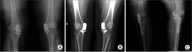 Advantages of Simultaneous Cementless Bilateral Unicondylar Knee Arthroplasty Compared to Staged Surgery.