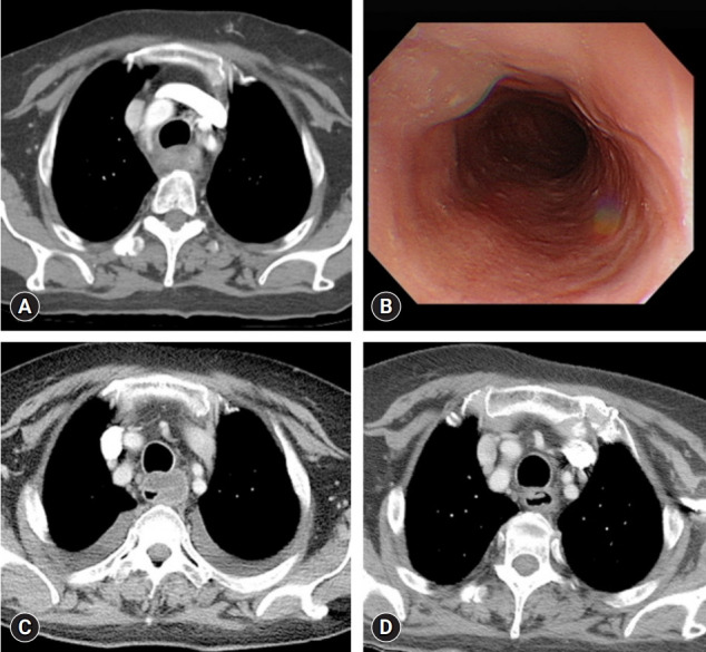 Treatment of phlegmonous esophagitis in various patients: a case series.