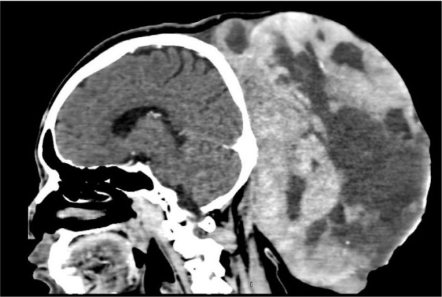 Fibrosarcomatous dermatofibrosarcoma protuberans: a rapidly growing 30 cm mass on the posterior scalp.