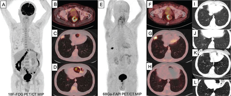 Pneumonia with Intense <sup>68</sup>Ga-FAPI Uptake Mimicking Metastasis on <sup>68</sup>Ga-FAPI PET/CT in a Patient with Rectal Cancer.