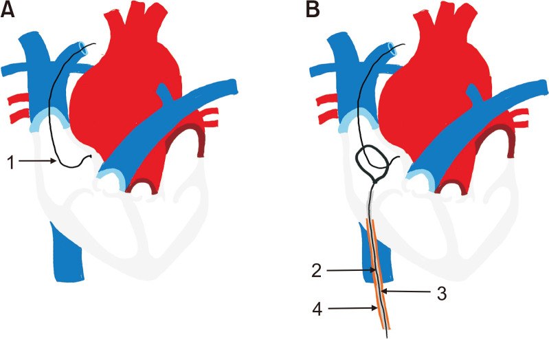 Layered Sheath-Assisted Dissection and Retrieval of Stuck Port Catheters: A Single-Center Experience.