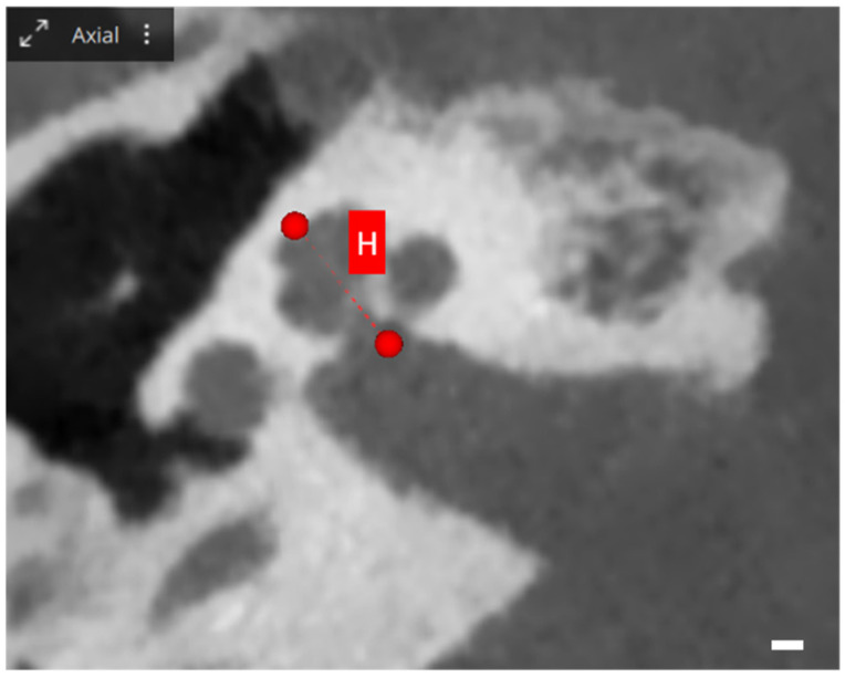 Otological Planning Software-OTOPLAN: A Narrative Literature Review.