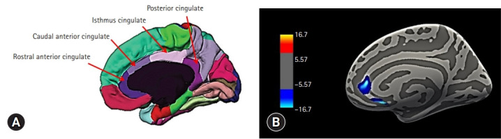 Cortical thickness of the rostral anterior cingulate gyrus is associated with frailty in patients with end-stage renal disease undergoing hemodialysis in Korea: a cross-sectional study.