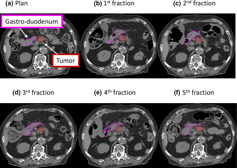 Predicting the daily gastrointestinal doses of stereotactic body radiation therapy for pancreatic cancer based on the shortest distance between the tumor and the gastrointestinal tract using daily computed tomography images.