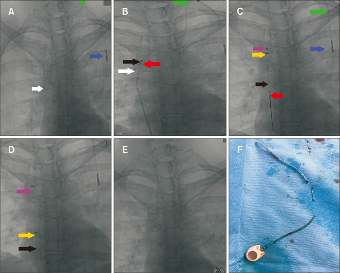 Layered Sheath-Assisted Dissection and Retrieval of Stuck Port Catheters: A Single-Center Experience.