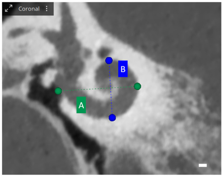 Otological Planning Software-OTOPLAN: A Narrative Literature Review.