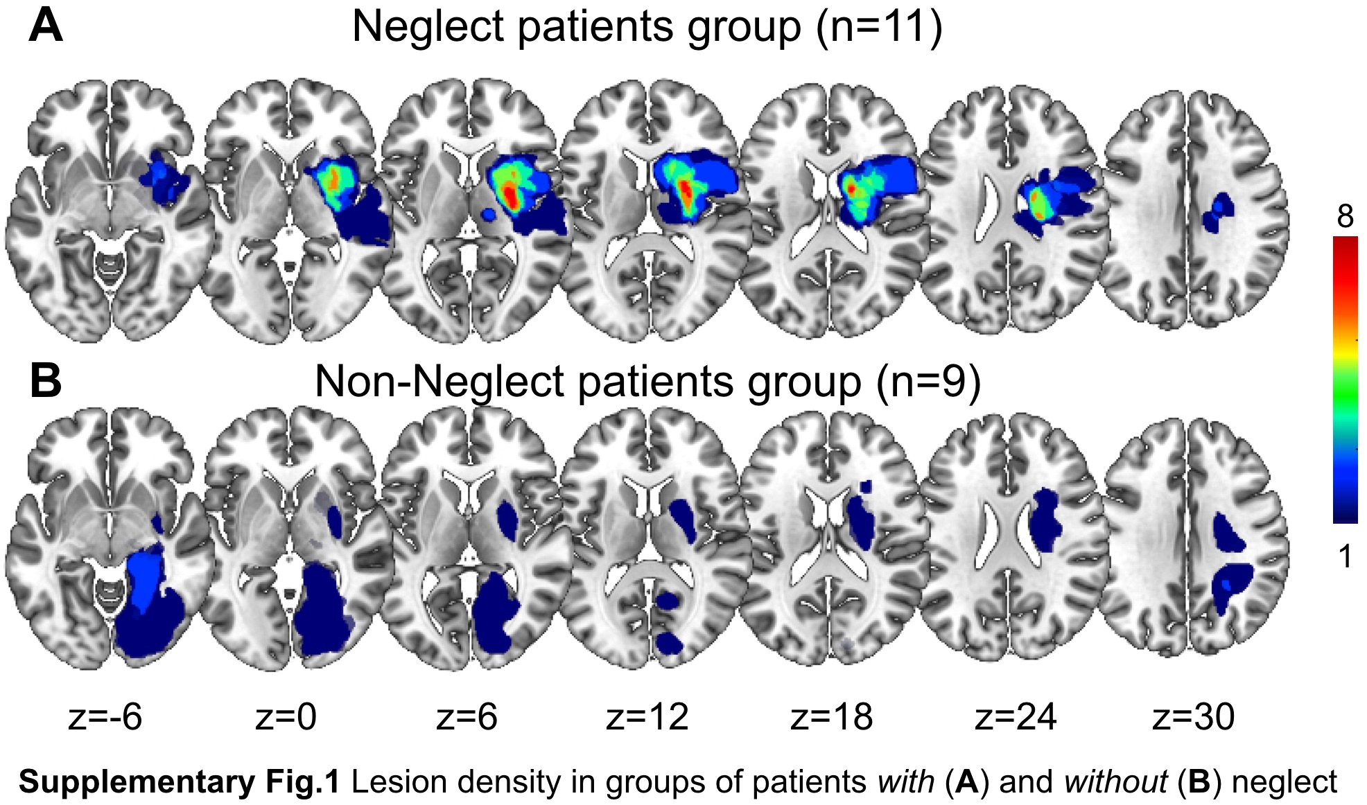 Brain Topological Reorganization Associated with Visual Neglect After Stroke.