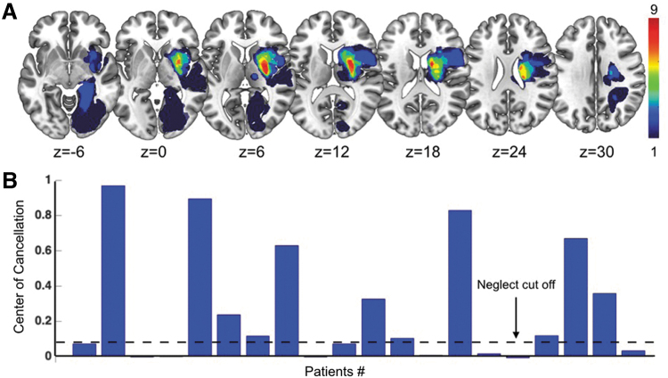 Brain Topological Reorganization Associated with Visual Neglect After Stroke.