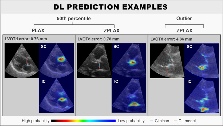 Deep learning for automated left ventricular outflow tract diameter measurements in 2D echocardiography.