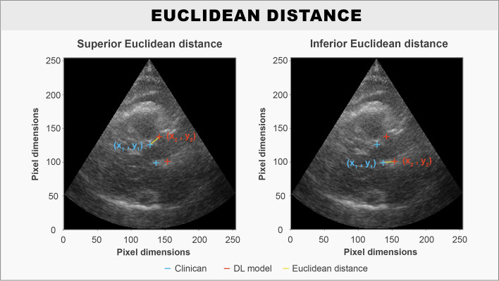 Deep learning for automated left ventricular outflow tract diameter measurements in 2D echocardiography.