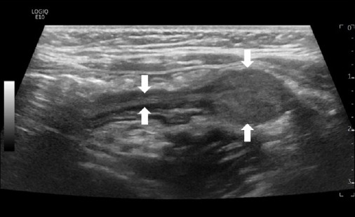 Successful detection and removal of predictable juvenile polyp: a case report.