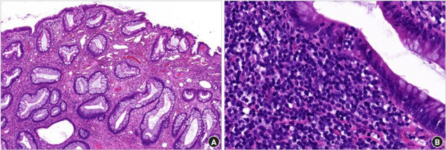 Successful detection and removal of predictable juvenile polyp: a case report.