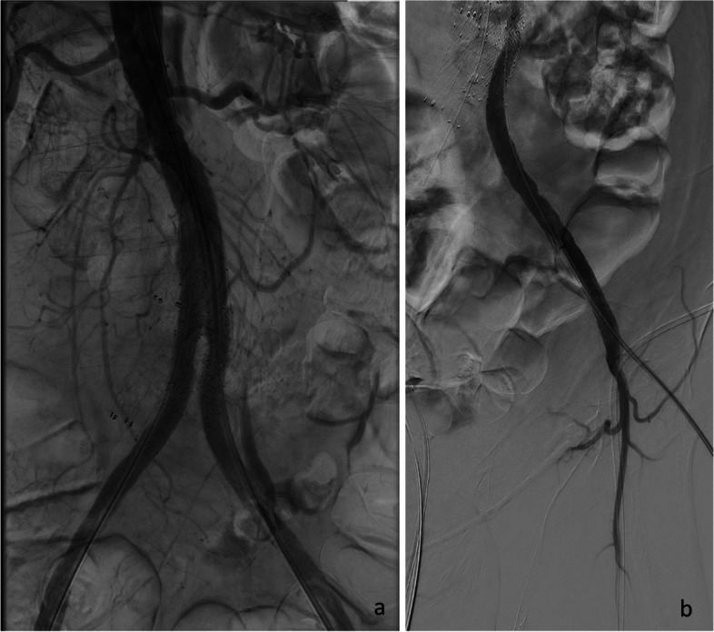 Neointimal dissection - a rare complication to endovascular treatment in grafts and stent grafts.