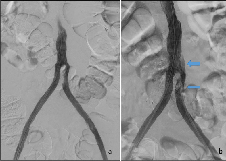 Neointimal dissection - a rare complication to endovascular treatment in grafts and stent grafts.