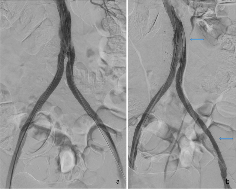 Neointimal dissection - a rare complication to endovascular treatment in grafts and stent grafts.