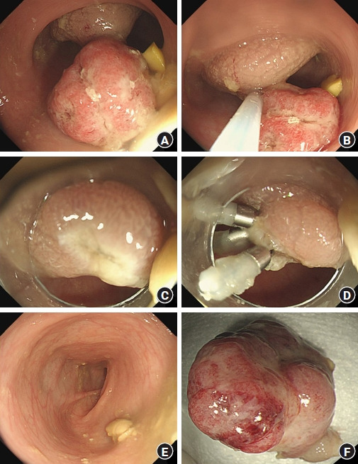 Successful detection and removal of predictable juvenile polyp: a case report.