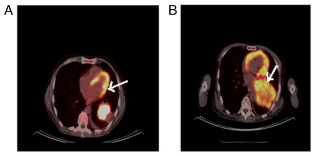 Issues with the targeted therapy of non‑small cell lung cancer with thyroid metastases: A case report.