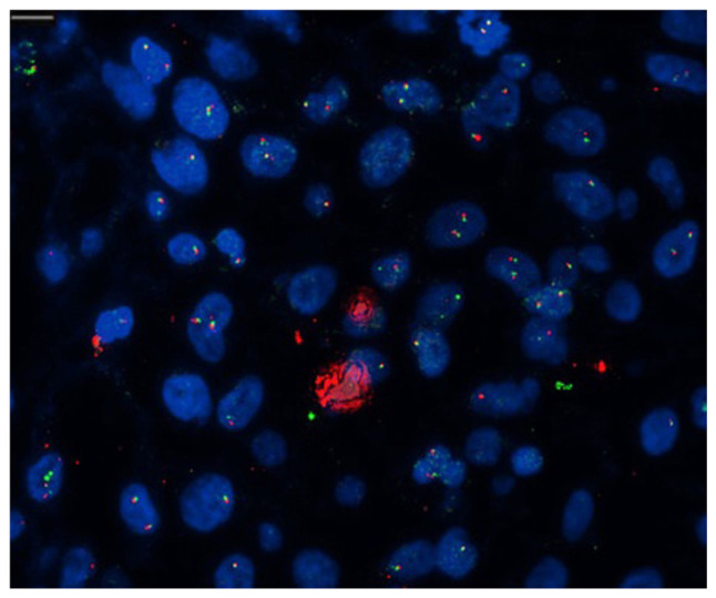 Issues with the targeted therapy of non‑small cell lung cancer with thyroid metastases: A case report.