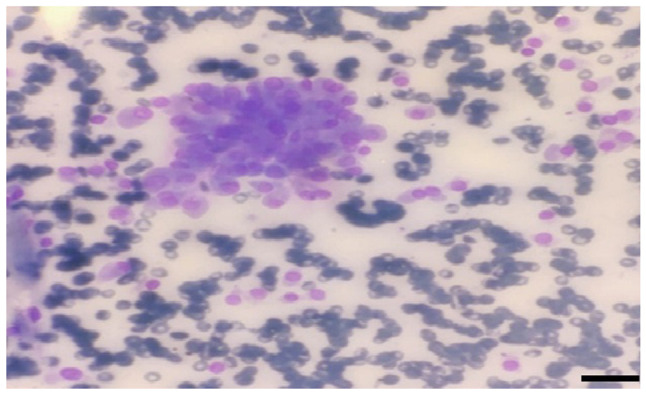 Issues with the targeted therapy of non‑small cell lung cancer with thyroid metastases: A case report.