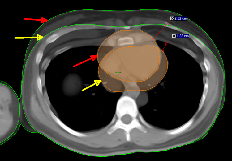 The Impact of Deep Inspiration Breath Hold (DIBH) Implementation on the Hybrid Technique in Left-Sided Whole Breast Irradiation: A Dosimetric Characteristic Study of 3D-CRT Hybrid VMAT in DIBH and Free Breathing Conditions, and VMAT in Free Breathing Conditions.