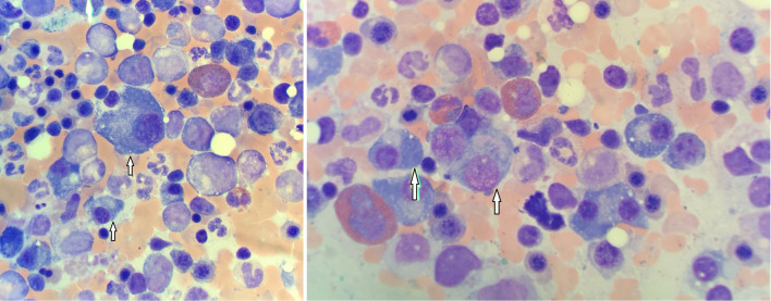 A Rare Coexistence of Multiple Myeloma and Polycythemia Vera.