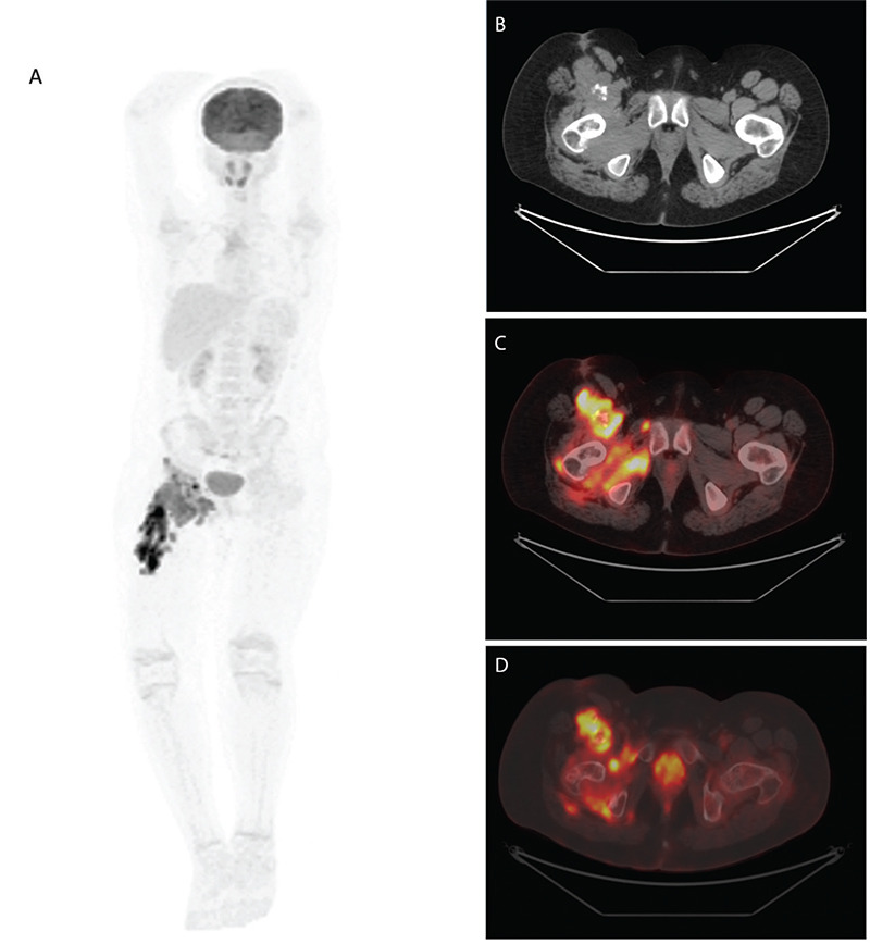 PET/CT Imaging of Inflammatory Myofibroblastic Tumor of the Thigh.