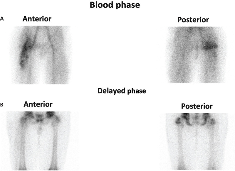 PET/CT Imaging of Inflammatory Myofibroblastic Tumor of the Thigh.