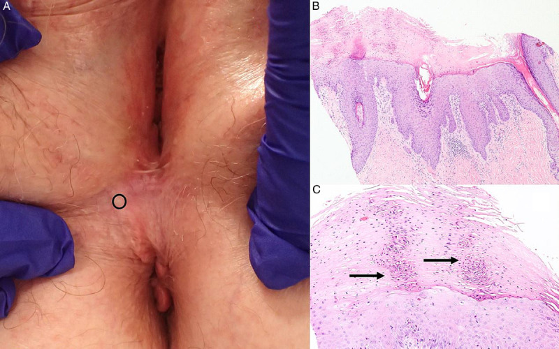 Nonsclerotic Lichen Sclerosus: Definition of a Concept and Pathologic Description.