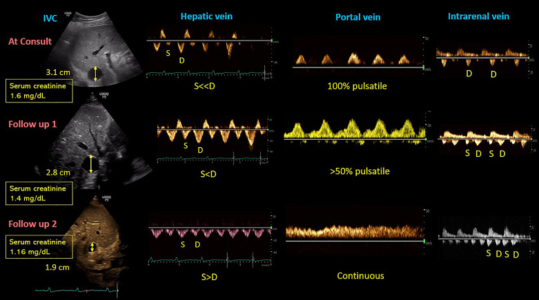 Venous Excess Doppler Ultrasound: A Visual Guide to Decongestion in Cardiorenal Syndrome.