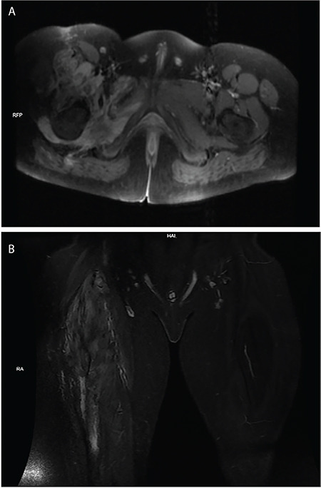 PET/CT Imaging of Inflammatory Myofibroblastic Tumor of the Thigh.