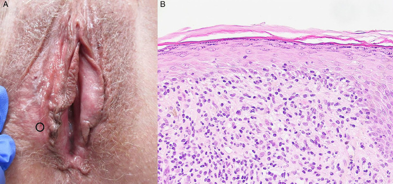 Nonsclerotic Lichen Sclerosus: Definition of a Concept and Pathologic Description.