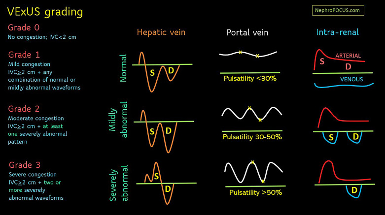 Venous Excess Doppler Ultrasound: A Visual Guide to Decongestion in Cardiorenal Syndrome.