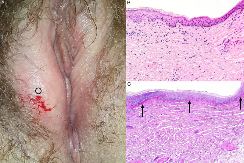 Nonsclerotic Lichen Sclerosus: Definition of a Concept and Pathologic Description.