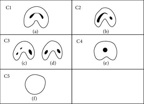 Prevalence and Morphology of C-Shaped Canals in Mandibular First and Second Molars of an Iranian Population: A Cone-Beam Computed Tomography Assessment.