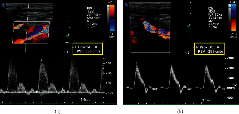 Coronary Artery and Peripheral Vascular Disease in a Patient with Poorly Differentiated Thyroid Cancer Treated with the Tyrosine Kinase Inhibitor Lenvatinib.