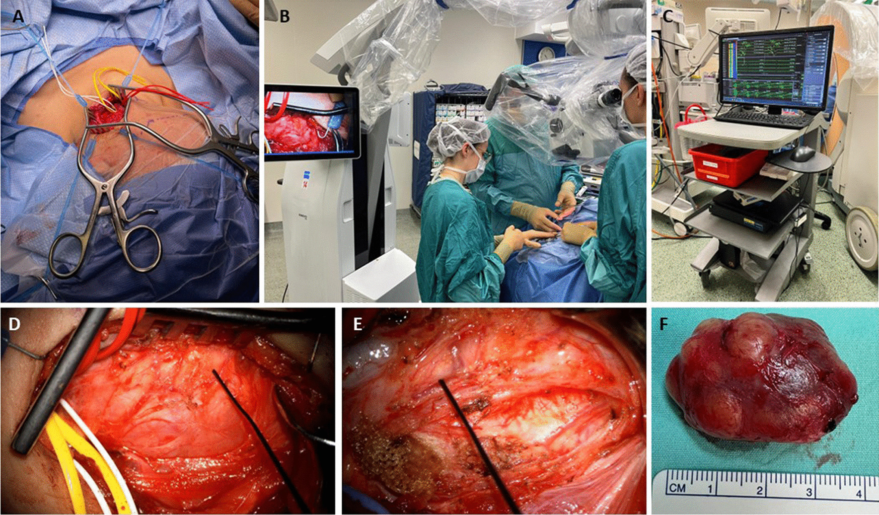 Functional outcome following intracapsular resection of head and neck peripheral nerve sheath tumors: a retrospective cohort.