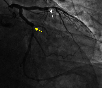 Coronary Artery and Peripheral Vascular Disease in a Patient with Poorly Differentiated Thyroid Cancer Treated with the Tyrosine Kinase Inhibitor Lenvatinib.