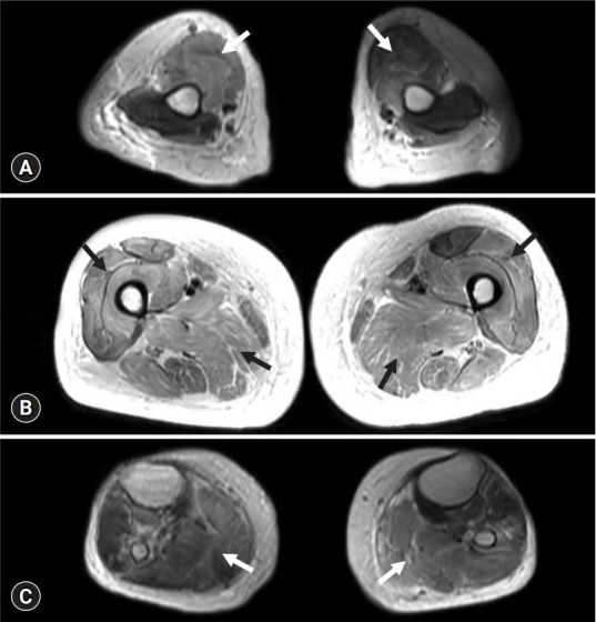 Intravesical bacillus Calmette-Guérin-induced myopathy presenting as rhabdomyolysis: a case report.