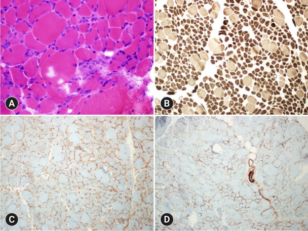 Intravesical bacillus Calmette-Guérin-induced myopathy presenting as rhabdomyolysis: a case report.