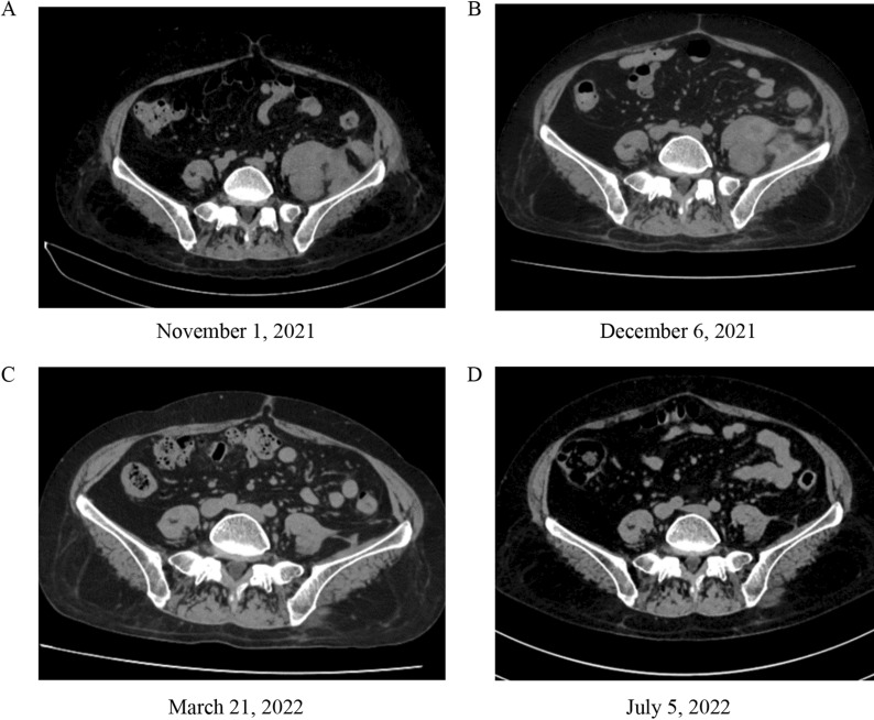 Severe asthma patient with secondary Citrobacter koseri abdominal infection: first case report and review of the literature.