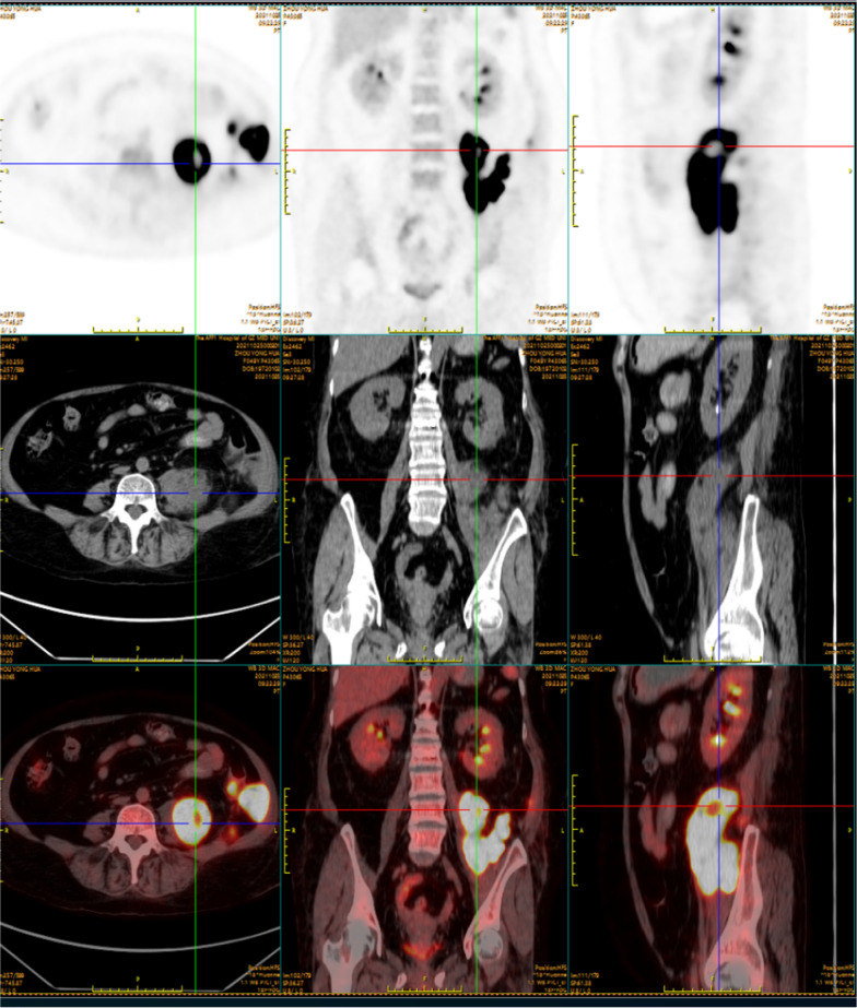 Severe asthma patient with secondary Citrobacter koseri abdominal infection: first case report and review of the literature.